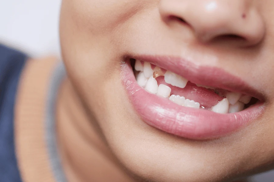 Broken Tooth Repair