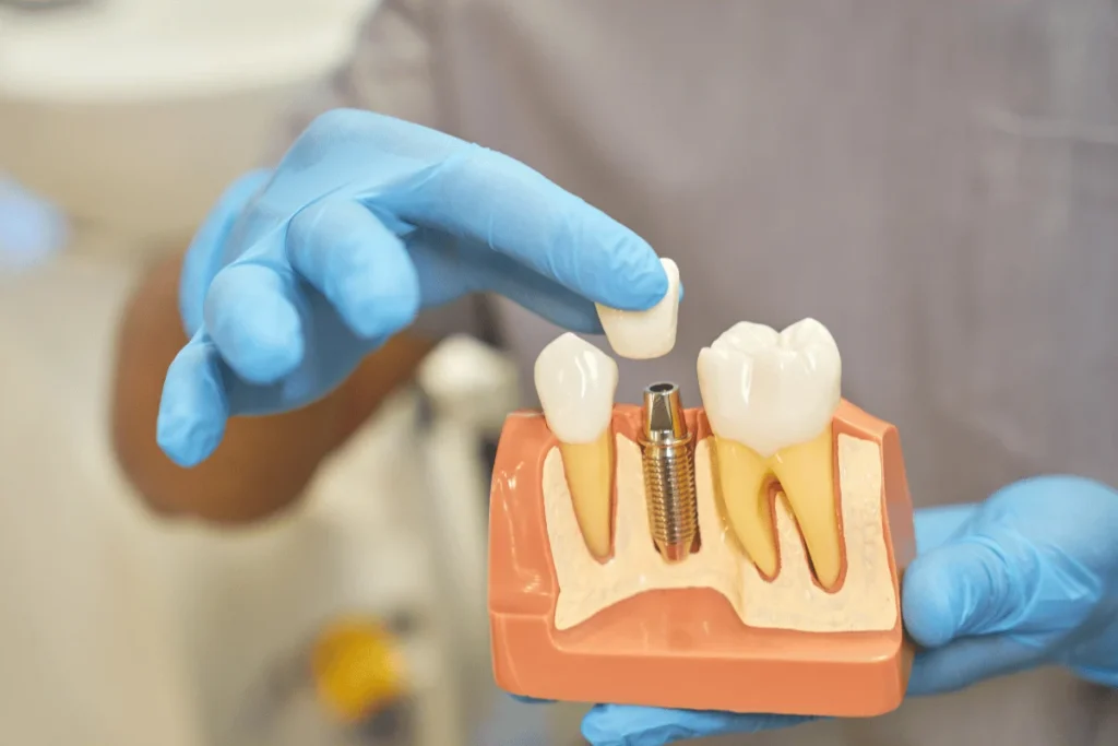 Dental Bridges
