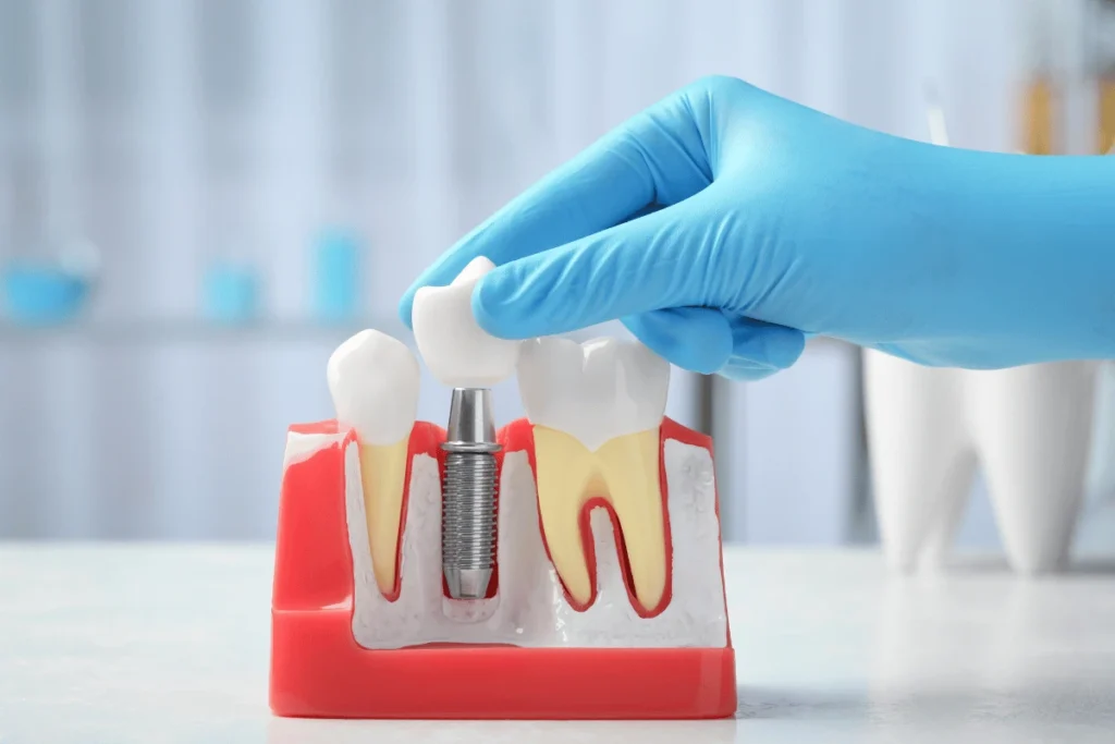 Implant Restorations