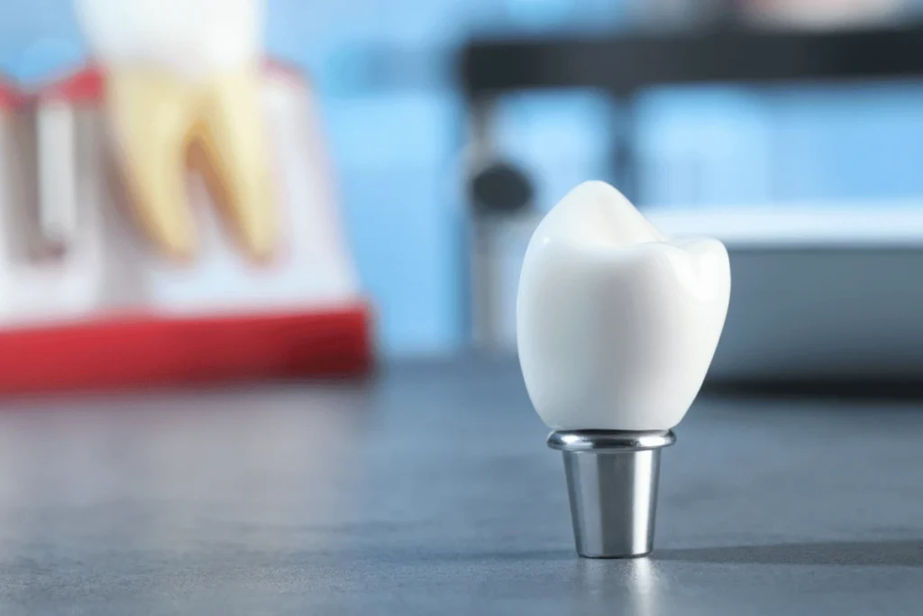 Single Tooth Implants
