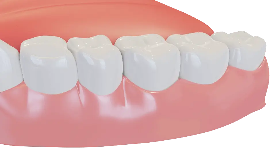 Dental Crowns