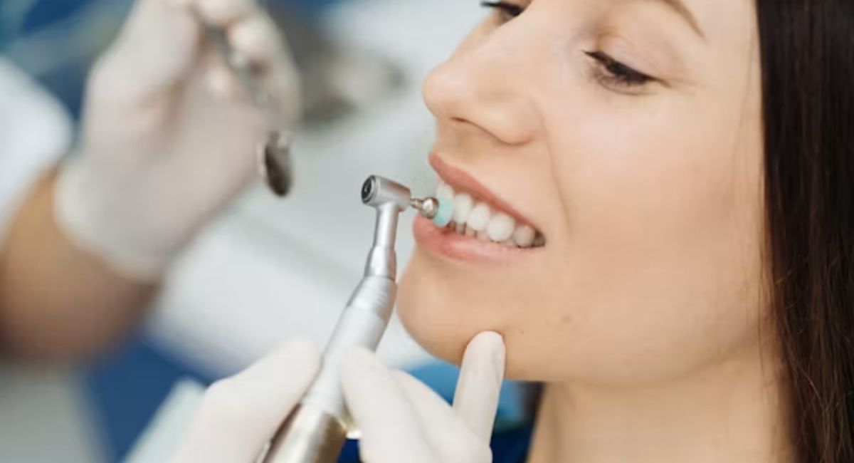 Veneers