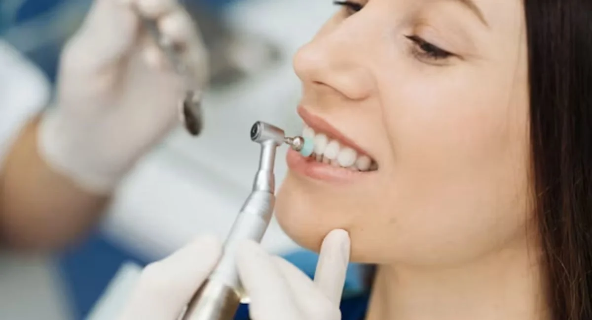 Veneers