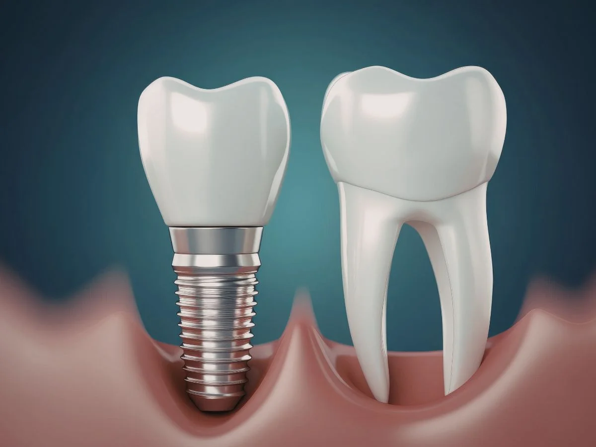 Dental Implants